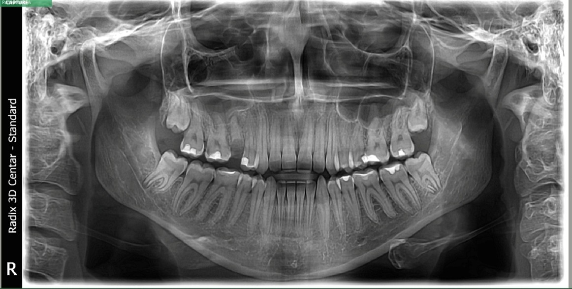 Ortopantomogram